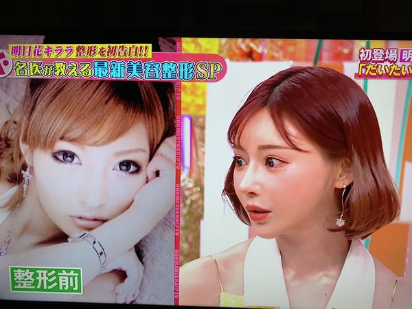 出道15年終於認了！明日花綺羅自爆整形「全臉都動過」但身材很純