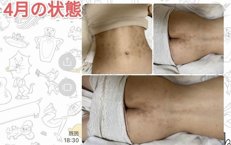 除毛搞得一身傷！寶生リリー(寶生莉莉)恐生涯終結！