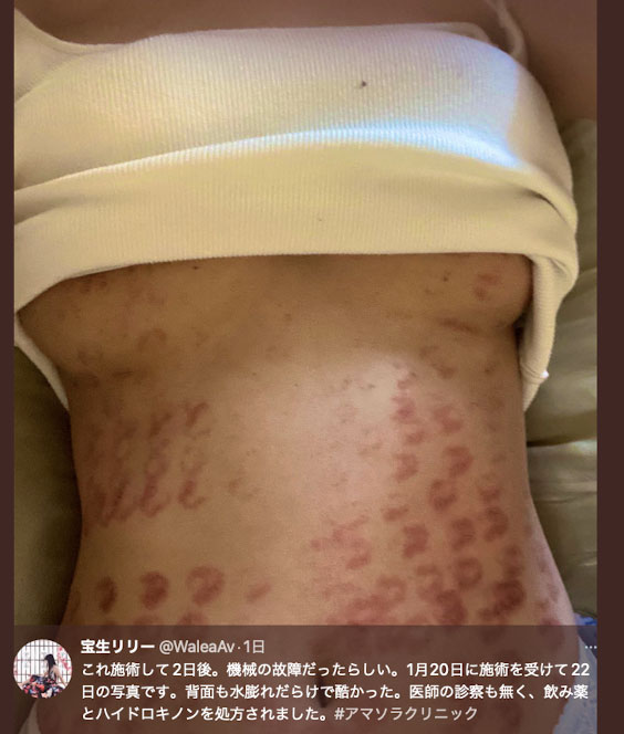 除毛搞得一身傷！寶生リリー(寶生莉莉)恐生涯終結！